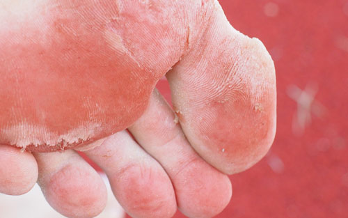 Athletes foot diagnosis with advanced symptoms