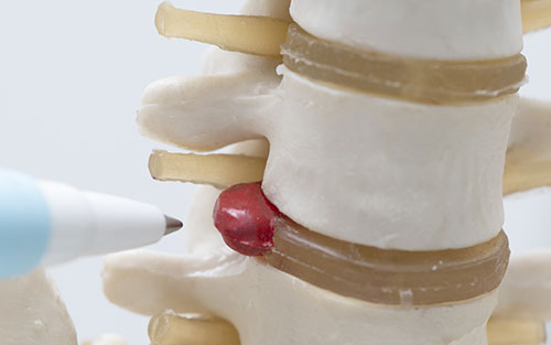 Upper back pain due to a herniated disc